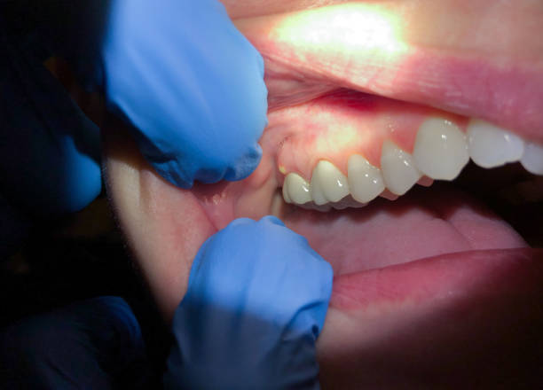 Best Broken or Cracked Tooth Emergency Dentist in Head Of The Harbor, NY